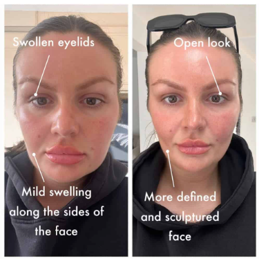 Brissea™ Lymphatic Brush